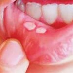 मुंह के छाले से निजात पाने घरेलू उपाय शहद